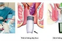 Chủ quan tưởng trĩ hóa ung thư 
