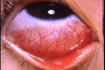 Viêm nhiễm bề mặt nhãn cầu do virus nhóm adeno 