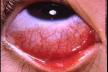 Viêm nhiễm bề mặt nhãn cầu do virus nhóm adeno 