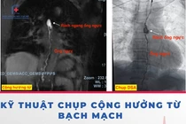 Can thiệp hệ bạch mạch cứu bệnh nhân tràn dịch