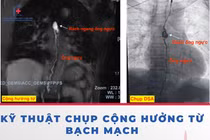 Can thiệp hệ bạch mạch cứu bệnh nhân tràn dịch