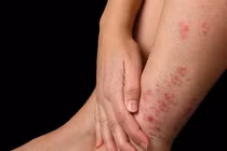 Điều trị vảy nến ở chân như thế nào cho hiệu quả?