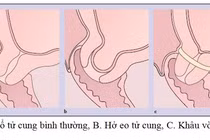 Khâu vòng tử cung cứu thai nhi 18 tuần tuổi