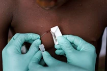 Nhiều nước tính tới việc tiêm ngừa bệnh đậu mùa khỉ