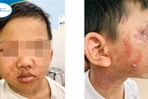 Viêm da tiếp xúc do kiến ba khoang lại chữa zona thần kinh