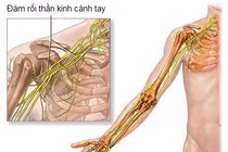 Mổ nối dây thần kinh