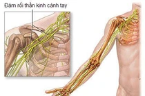 Mổ nối dây thần kinh