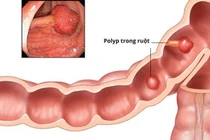 Cảnh giác với polyp đại trực tràng ở trẻ nhỏ