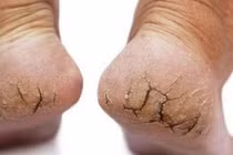 Cắt nứt nẻ khiến chân hoại tử