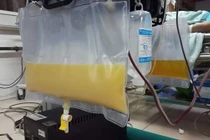 Mẫu huyết tương đục như sữa