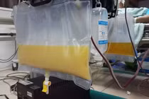 Mẫu huyết tương đục như sữa