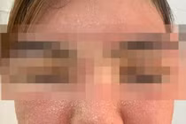 Sưng phù mặt vì đắp mặt nạ không rõ nguồn gốc 