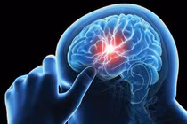 Giải pháp cải thiện tai biến tiểu não hiệu quả nhờ sản phẩm có thành phần từ thiên nhiên