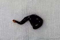 Con đỉa được gắp ra khỏi mũi bệnh nhân