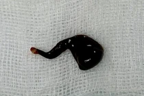 Con đỉa được gắp ra khỏi mũi bệnh nhân