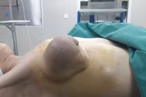 U vú đặc biệt phát triển nhanh vì chữa thuốc Nam