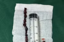 Lấy đoạn huyết khối dài hơn 40cm tránh cắt cụt chi