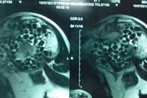 Đau chân phát hiện sỏi khớp