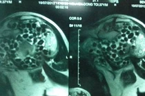 Đau chân phát hiện sỏi khớp