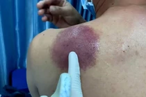 Phát hiện ung thư dạ dày từ tổn thương trên da 