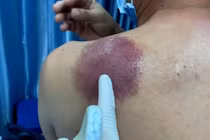 Phát hiện ung thư dạ dày từ tổn thương trên da 