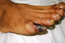 Điều trị viêm tắc động mạch chi bằng YHCT