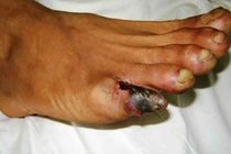 Điều trị viêm tắc động mạch chi bằng YHCT