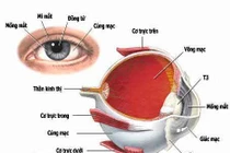 Viêm dây thần kinh thị giác do bệnh toàn thân