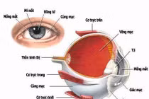 Viêm dây thần kinh thị giác do bệnh toàn thân