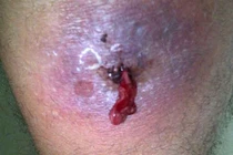 Cẩn thận vết xước da thành viêm mô tế bào