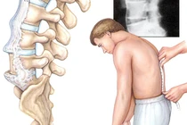 Đau thắt lưng và biểu hiện của cột sống dính khớp