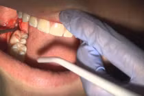 Viêm ổ răng sau nhổ