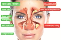 Cách nhận biết viêm xoang mặt