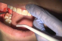 Viêm ổ răng sau nhổ