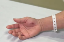 Hy hữu: Ngộ độc vì bị Cu li cắn