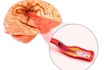 Những bệnh lý làm tăng nguy cơ bị đột quỵ ở người cao tuổi