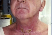 Cách khắc phục viêm da do tia xạ