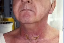 Cách khắc phục viêm da do tia xạ