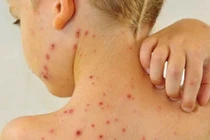 Nguyên tắc phòng trị bệnh thủy đậu