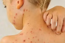 Nguyên tắc phòng trị bệnh thủy đậu