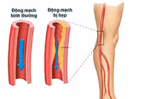 Cách phòng ngừa bệnh động mạch chi dưới tránh hoại tử