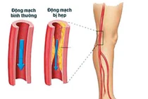 Cách phòng ngừa bệnh động mạch chi dưới tránh hoại tử