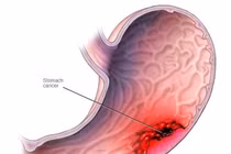 Xét nghiệm nồng độ pepsinogen phát hiện sớm ung thư dạ dày 