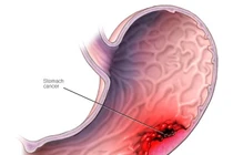 Xét nghiệm nồng độ pepsinogen phát hiện sớm ung thư dạ dày 