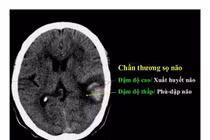 Điều trị chấn thương sọ não nặng nhờ đặt máy đo áp lực nội sọ