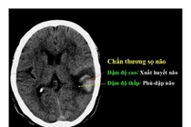 Điều trị chấn thương sọ não nặng nhờ đặt máy đo áp lực nội sọ