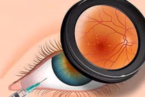 Tránh bị đục thủy tinh thể