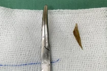 Chiếc xương cá đâm ra ngoài ruột non