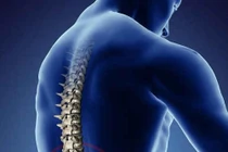 Phẫu thuật gai cột sống dễ tái phát