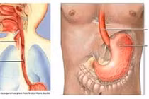 Giãn tĩnh mạch thực quản độ mấy phải thắt?